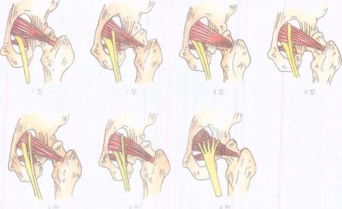 屁股痛、腿麻,有块肌肉受伤了