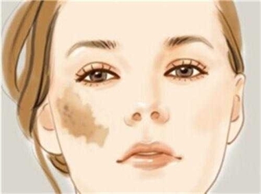 30岁以后脸上有斑怎么护理,怎样区分脸上的是斑还是痣