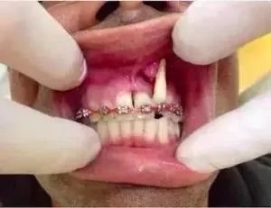 拼多多6d牙齿矫正牙套可靠吗,拼多多上买的牙套靠谱吗