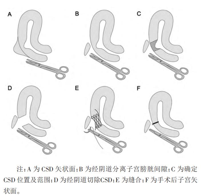两个大头宝宝，让我经历了两次剖宫产