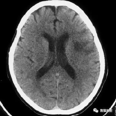 脑梗死丨演变、血供区域分布、CT表现