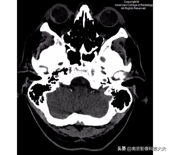 一39岁男子争吵后，右眼突然瞎了，病例分析知答案