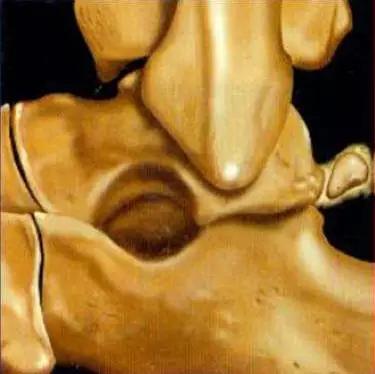 踝关节撞击症问诊,踝关节内侧撞击综合症位置图