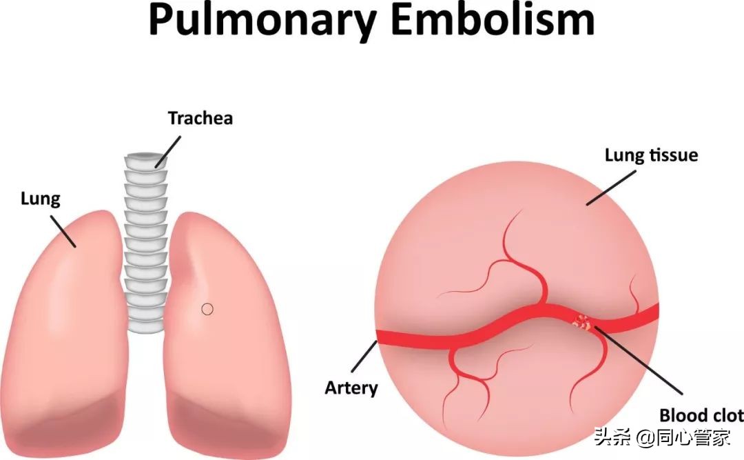 是不是有的血栓也不要过度治疗,能彻底治疗血栓吗