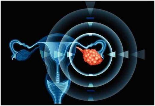 卵巢癌复发肠梗阻的早期症状,卵巢囊肿是卵巢癌的早期症状吗