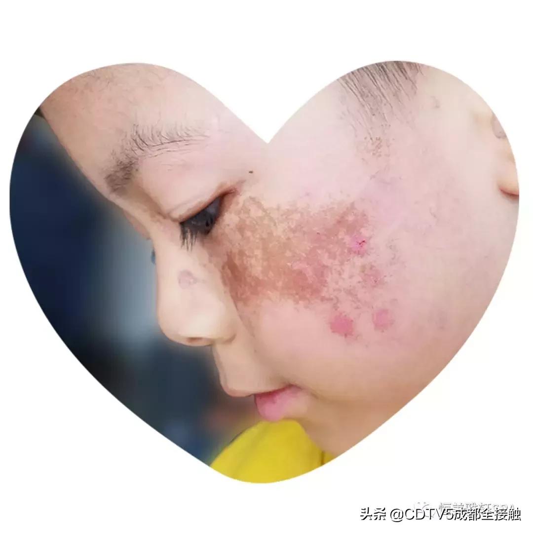 恒美胎记,恒美公益