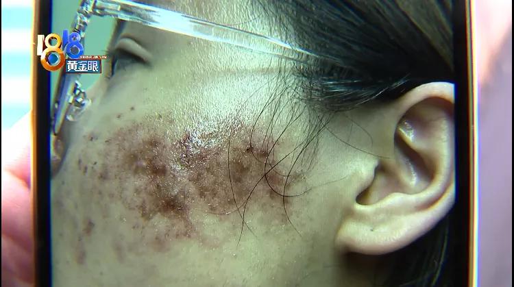 光子嫩肤后满脸黑点,光子嫩肤结痂想化妆怎么办