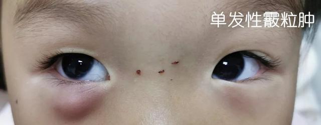 眼睛感染过后麦粒肿还是霰粒肿,眼皮红肿麦粒肿霰粒肿形成机理