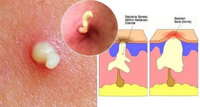 痘痘里面挤出来的白色东西用什么药,痘痘里面挤出来的白色东西是什么怎么治疗