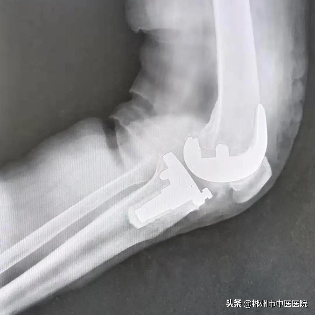 专家支招骨关节炎治疗,膝关节骨性关节炎疼痛怎么治疗