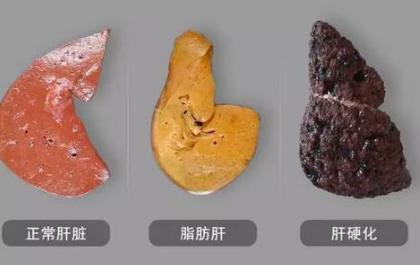 轻度脂肪肝肝功能正常血脂偏高,什么是轻度脂肪肝