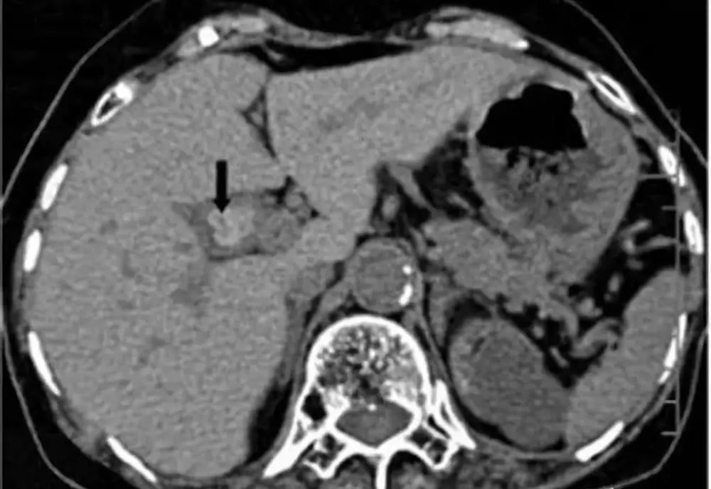 肠息肉胃息肉,肠息肉和胆囊息肉必须做手术吗