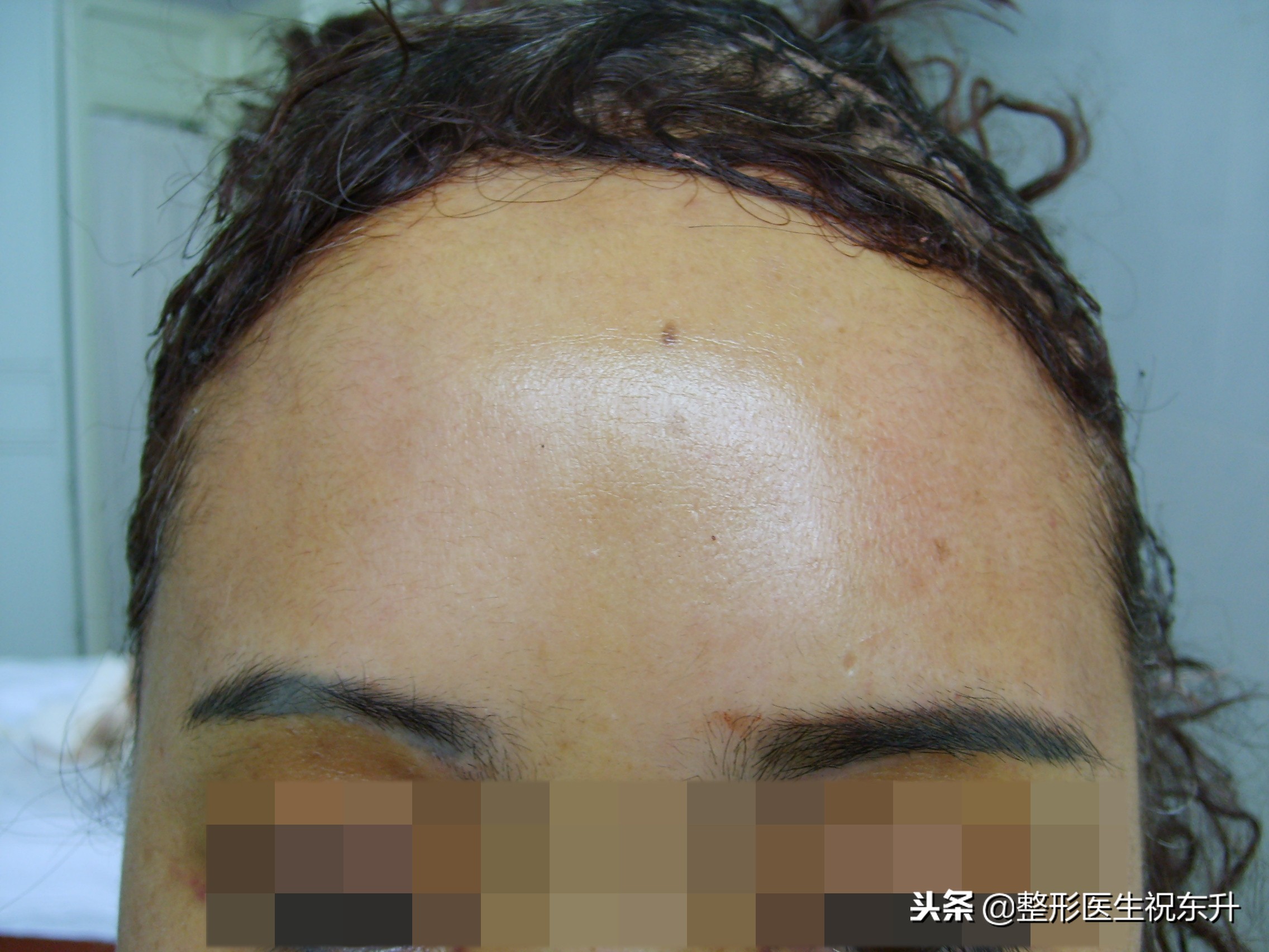 额颞部除皱去抬头纹怎么样,拉皮除皱抬头纹全过程视频