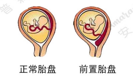 VIDA·READY孕妈课堂：胎盘前置，尤须警惕