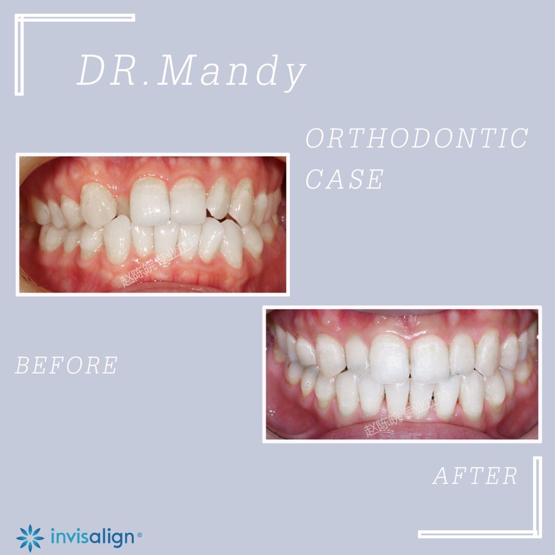 厦门牙齿矫正前后对比,牙齿矫正对脸型的改变有多大知乎