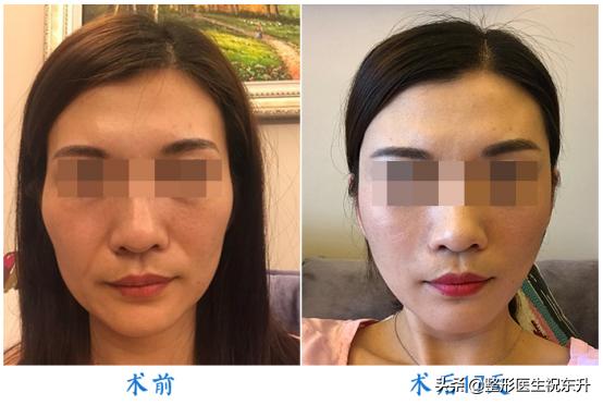 面部五层提升可以维持多久,做完面部提升三件套