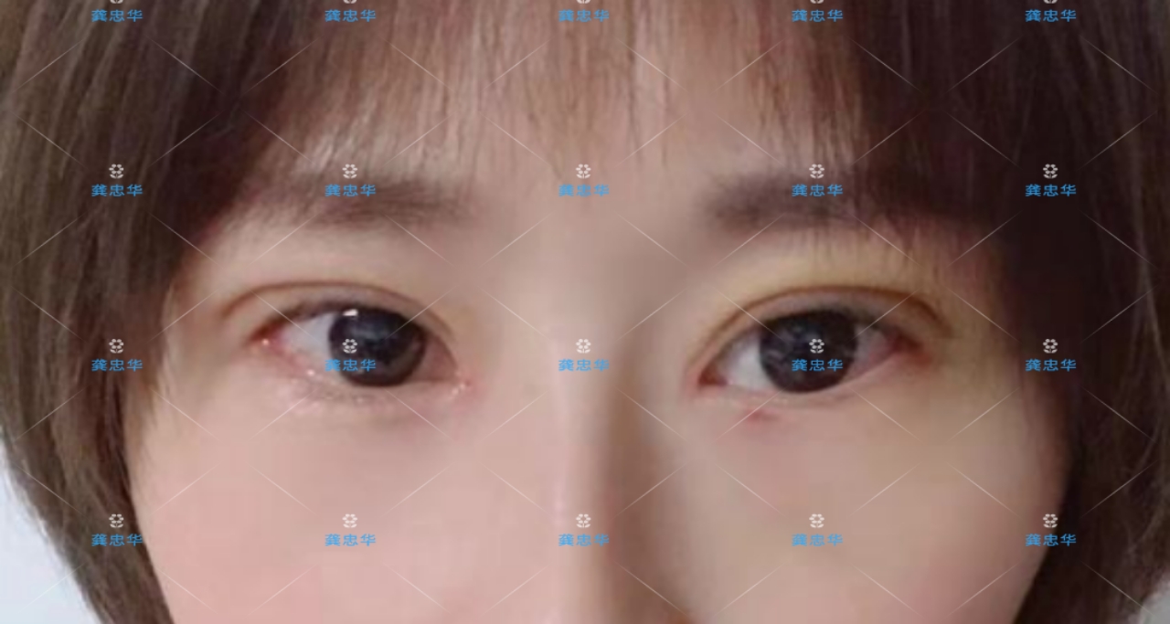 眼皮松弛可以做埋线双眼皮吗,埋线双眼皮眼皮松弛了该怎么办