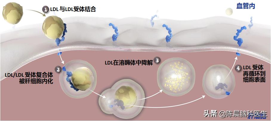 动脉粥样硬化闭塞症药物上市,动脉粥样硬化斑块能够药物消除吗