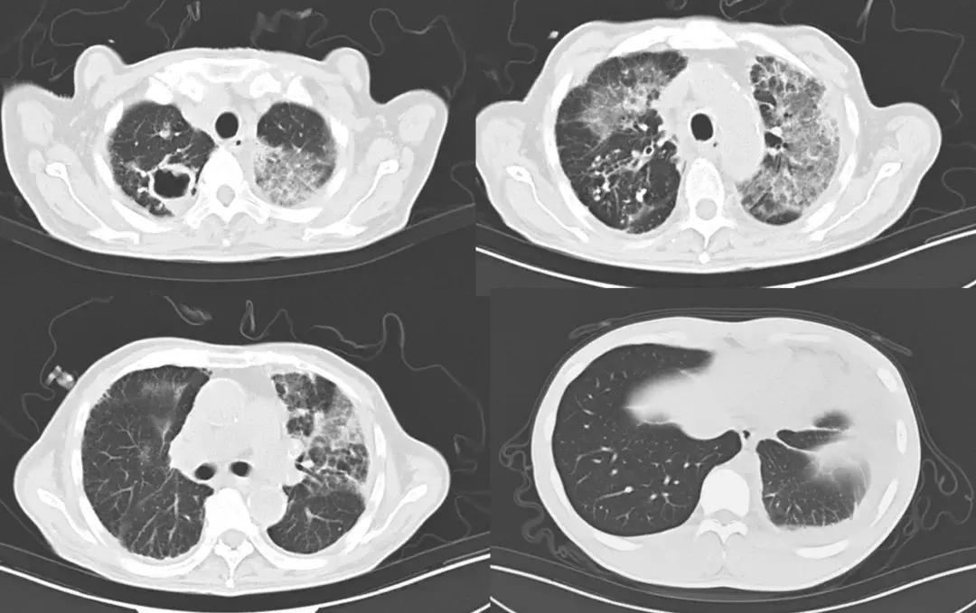 病例分享：无计可施时「黑色的」胸腔积液使治疗找到了方向