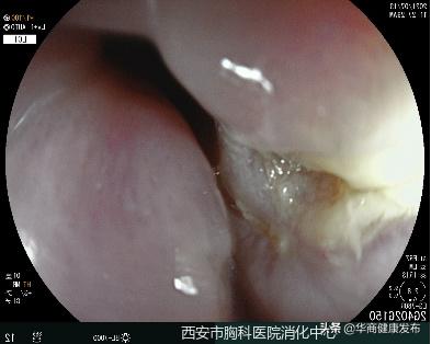 骨鲠,消化内镜可以做什么治疗
