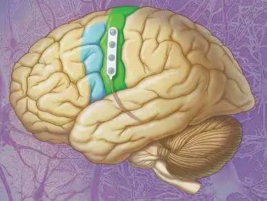 骶神经刺激器植入术效果,全面开展神经调控技术