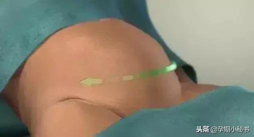 顺产生孩子剖腹产的真实流程,顺产剖腹产生孩子的真实流程