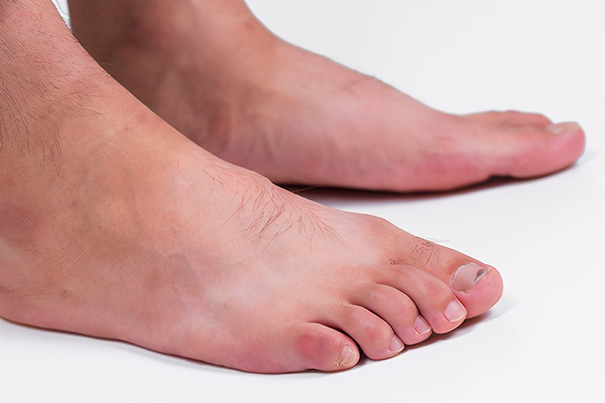 甲沟炎断甲嵌在肉里怎么办,为什么甲沟炎脚趾肉会是硬块