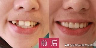 淄川口碑最好的矫正牙齿医院,淄博市口腔医院哪个专家整牙好