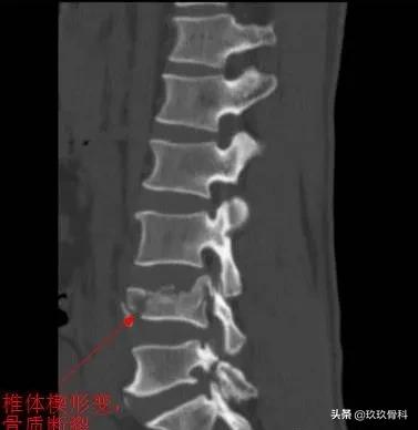病例实讲|你是否也将其误诊为椎体骨折