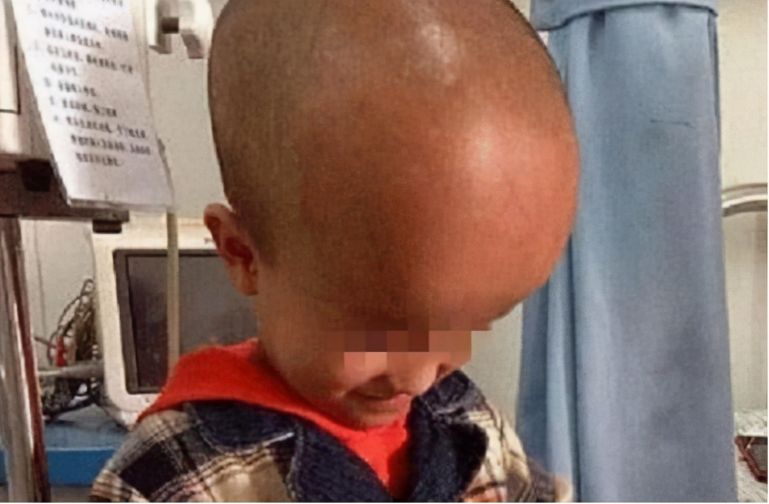 三聚氰胺祸害了多少儿童,当年的三聚氰胺孩子现状况