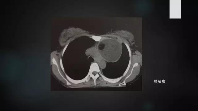 胸腺增生和纵隔肿瘤的区别和症状,纵隔胸腺肿瘤的常见临床症状表现