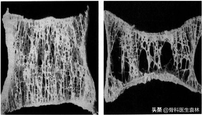 老年人腿抽筋是缺钙引起的吗,腿抽筋缺钙该怎么补钙呀