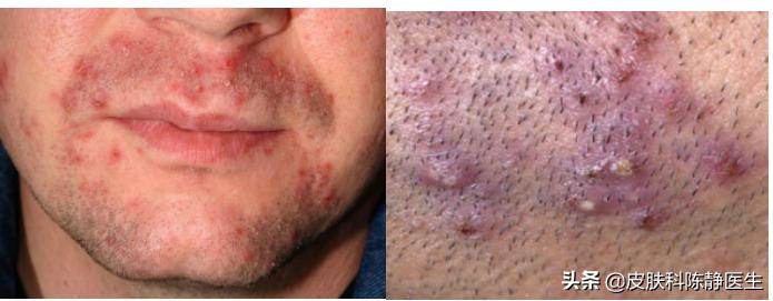 怎么避免一刮胡子就毛囊炎,刮胡子容易得毛囊炎怎么办