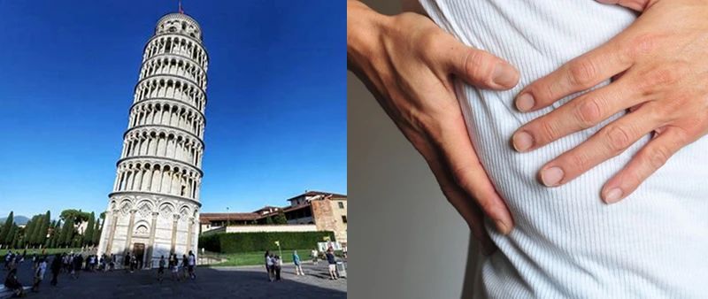 肋骨外翻治不了,练核心可以修正肋骨外翻吗