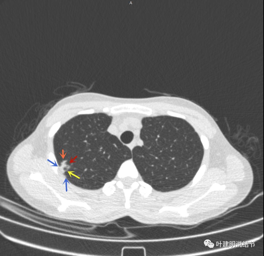 临床诊断孤立性肺结节,空洞型结节一般是什么性质