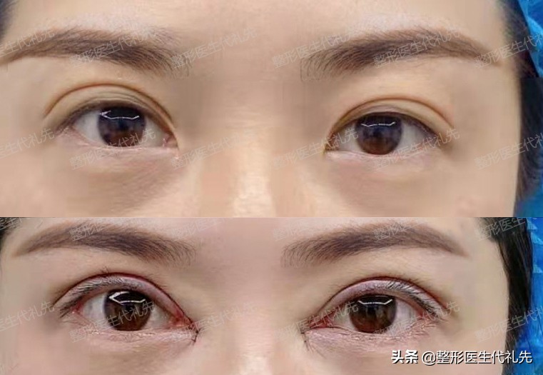 聊一聊眼睛手术,双眼皮怎么选看完你就知道了