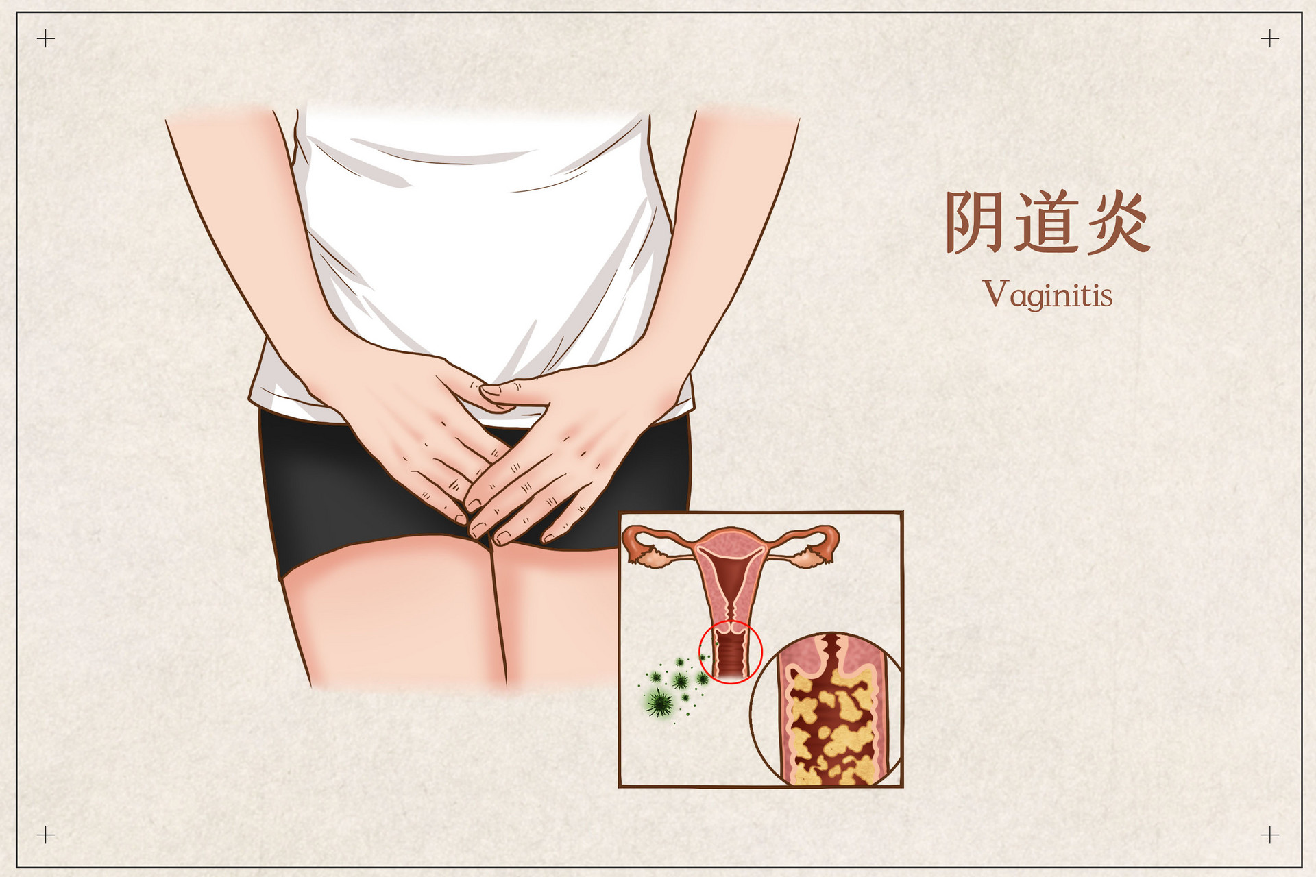 已婚女性反而容易患妇科病，这是怎么回事？日常做好3点可预防