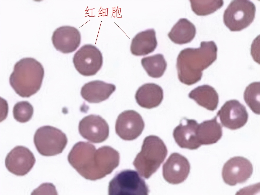 经期剧烈运动后尿血,运动后尿血是什么原因