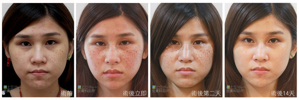 皮秒镭射可以去什么斑,皮秒镭射的正确方法