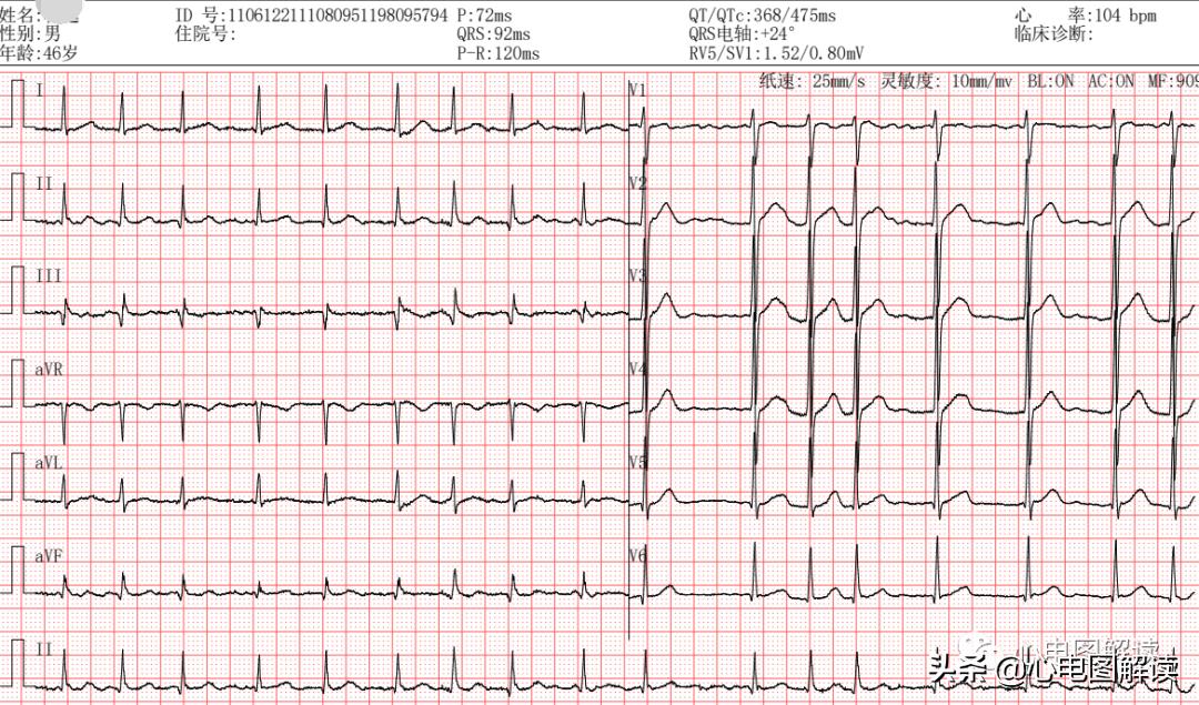 心房颤动的诊疗,心房颤动怎么自查