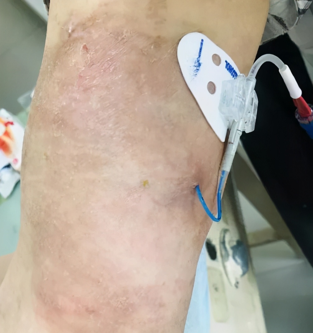 picc置管敷贴皮肤痒如何处理,picc置管防过敏贴膜进口