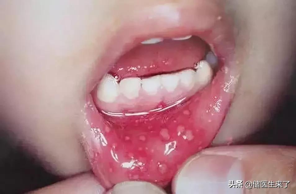 24种皮肤病用药指南,儿童皮肤病的症状和治疗方法