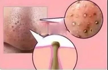 棰濆ご绮夊埡闂彛鎬庝箞鍘婚櫎,鍘婚櫎闂彛绮夊埡鐨勬姢鑲ゅ搧