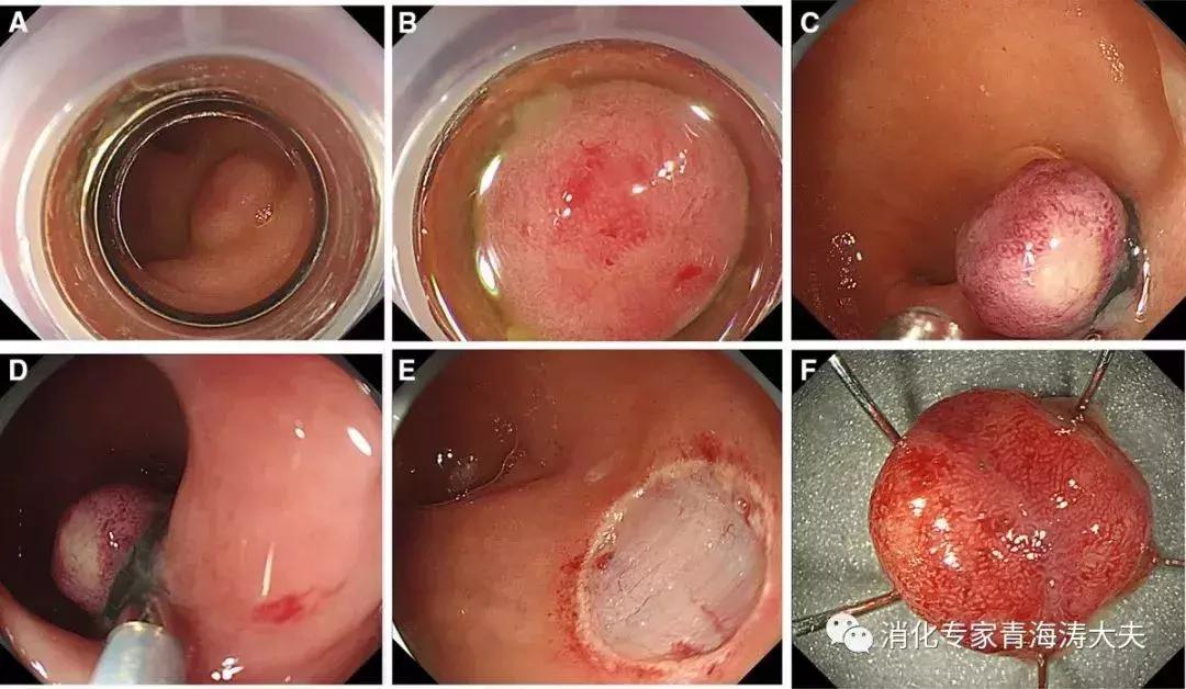 十二指肠神经内分泌瘤低度恶性,胰十二指肠切除术教学查房