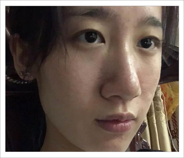 根除脸上螨虫的简单方法,螨虫在脸上如何彻底消除