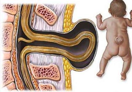 成人发现先天性脊柱裂怎么办,警惕脊柱裂图片