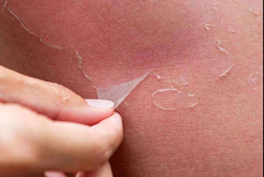 不小心晒伤怎么办?家居必备护理方法分享