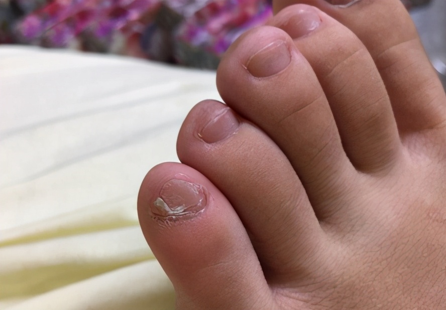 小脚趾甲两瓣一定是汉族人么,小脚趾甲一瓣的人是什么民族