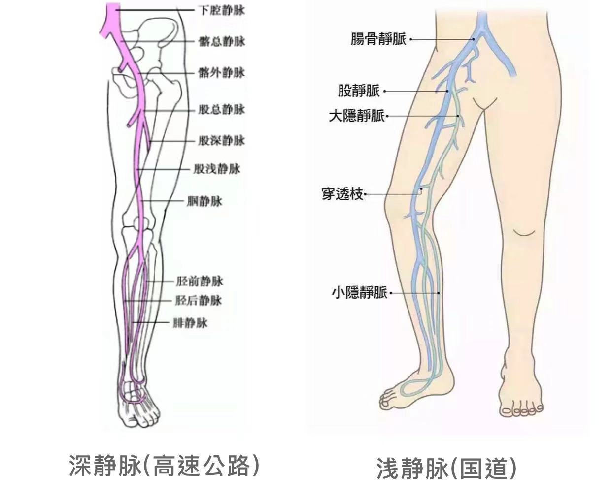 小腿有静脉曲张是血管淤堵吗,静脉曲张血管堵塞有什么症状