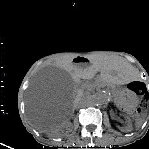肝硬化肝囊肿要治疗吗,肝包虫囊肿与肝囊肿